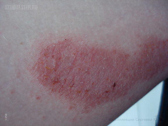 Экзема микробная (монетовидная) и гепатит В. Случай №459 из ...